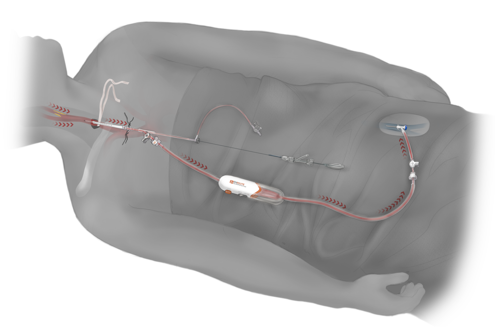 TCAR Illustration
